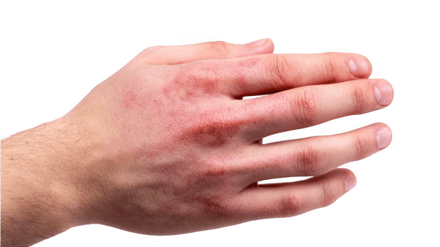 Hand showing contact dermatitis symptoms on transparent background png