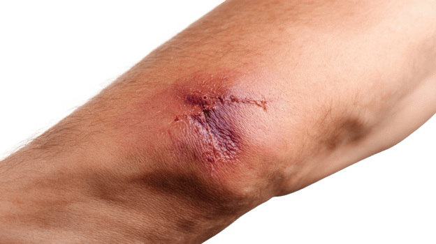 Close up of deep bruise and scar on elbow with transparent background png
