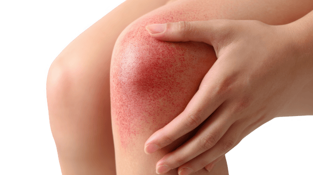 Woman touching red rash on leg behind knee on transparent background png
