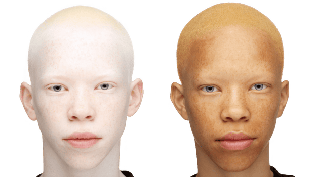 Albinism and melanin showing different skin colors on transparent background png