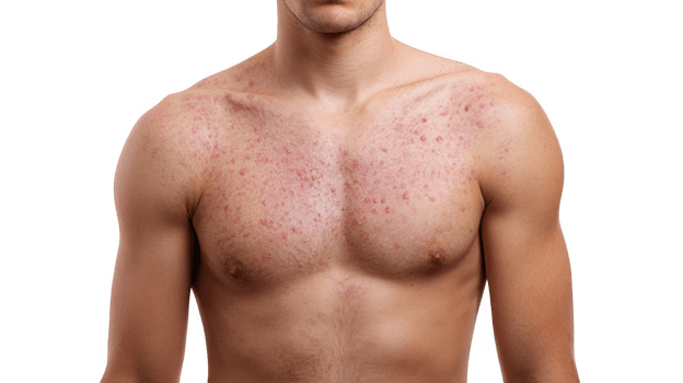 Man showing measles rash on chest and shoulders on transparent background png