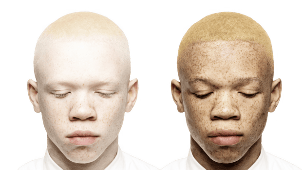 Albinism and melanin showing skin tone variation on transparent background png