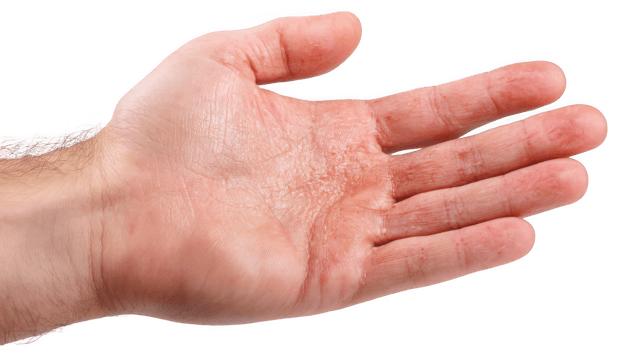 Hand showing blisters and dry skin on palm with transparent background png