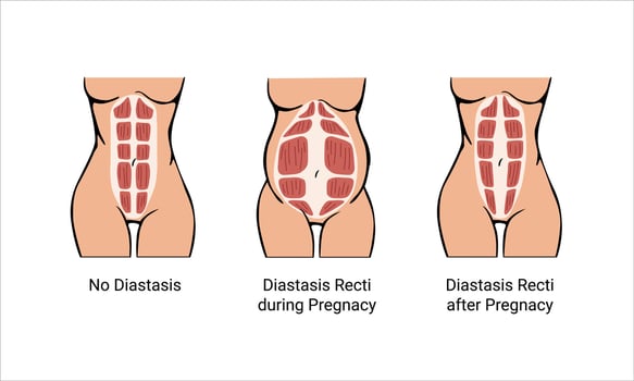 Diastasis recti stages during pregnancy vector