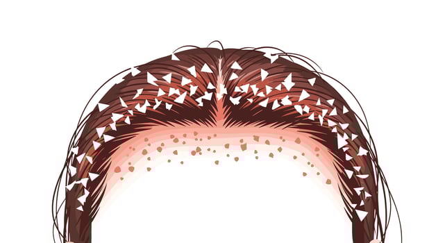 Understanding Dandruff Prevention and Treatment A Guide to Scalp Health and Relief vector