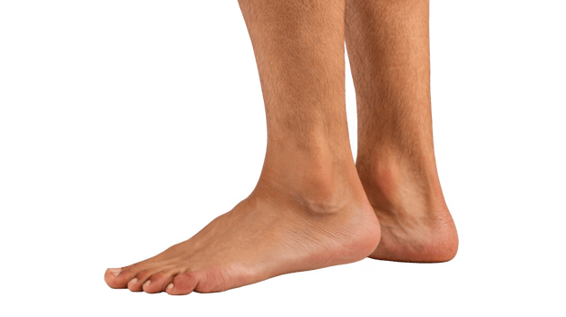 Swollen ankle showing signs of inflammation on transparent background png