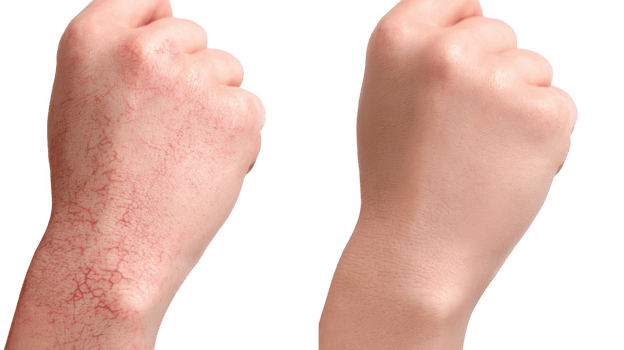 Eczema and psoriasis comparison on transparent background showing skin improvement png
