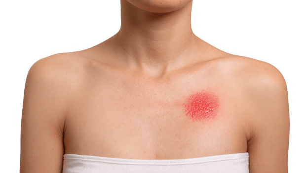 Woman showing red sunburned skin patch on chest on transparent background png