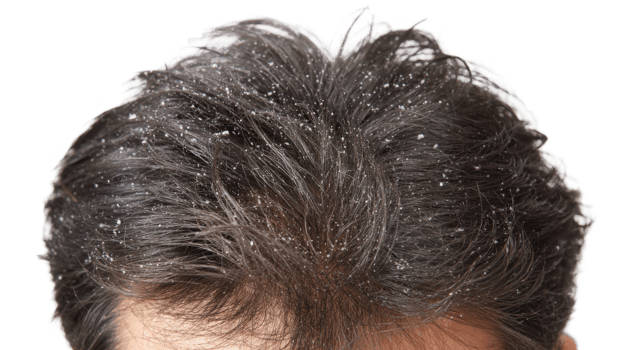 Close up of dandruff flakes on dark hair with transparent background png