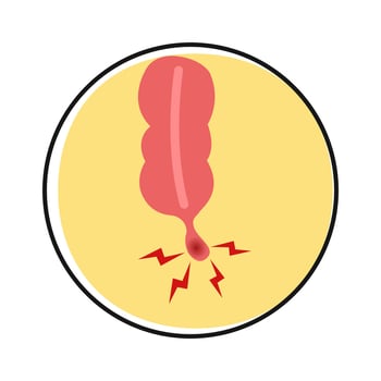 Cartoon of appendicitis symptoms vector