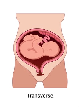 Baby in transverse position inside uterus vector