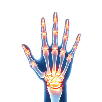 X ray of a human hand with highlighted joints. png