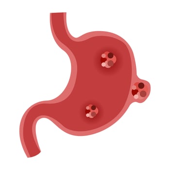 Stomach cancer disease vector