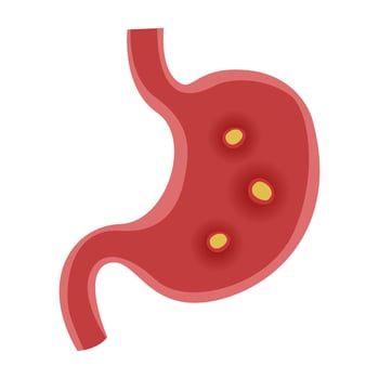 Stomach ulcer disease. vector