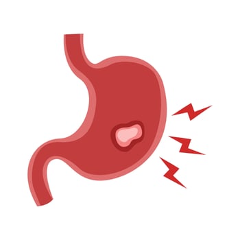 Stomach ulcer disease vector