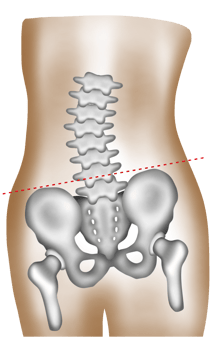 A hand-painted watercolor of lumbar scoliosis causing uneven hip height png