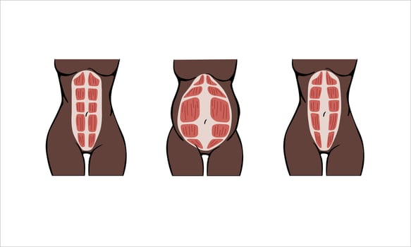 Different types of Diastasis. Dark-skinned woman. Diastasis in a woman before, during and after pregnancy. The anatomy of a Woman. A woman's muscular corset before and after childbirth. vector