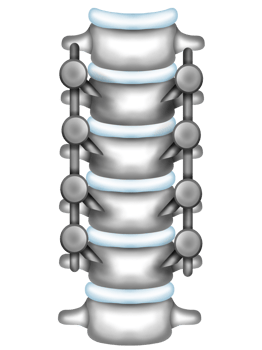Spine with metal braces png