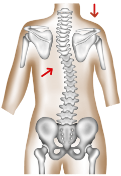 Hand-painted watercolor of a thoracolumbar scoliotic spine causing uneven scapula and shoulder height png