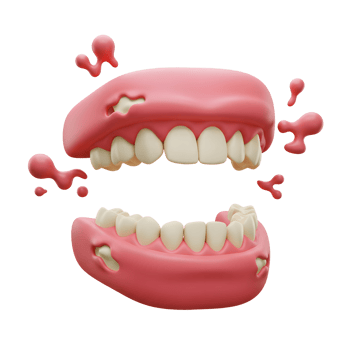 Cartoon teeth with damaged gums showing tooth decay, suitable for illustrating dental health problems. png