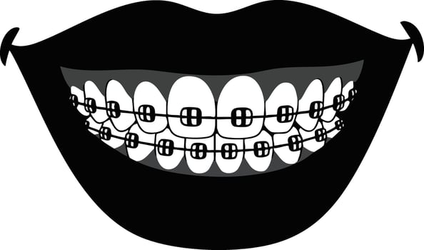 Smiling mouth with braces dental orthodontics teeth correction design illustration vector