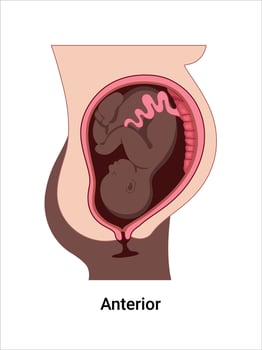 Anterior baby positions in the uterus during pregnancy. Dark-skinned woman. Pathology. Detailed medical illustration. Fetus with umbilical cord, placenta. vector