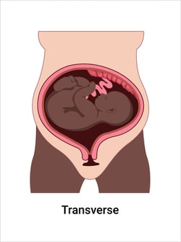 Transverse baby positions in the uterus during pregnancy. Dark-skinned woman. Pathology. Detailed medical illustration. Fetus with umbilical cord, placenta. vector