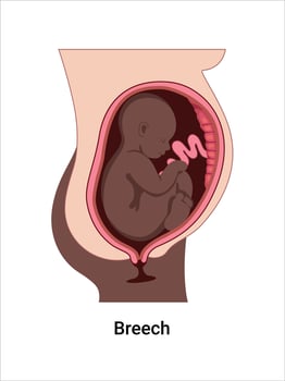 Breech baby positions in the uterus during pregnancy. Dark-skinned woman. Pathology. Detailed medical illustration. Fetus with umbilical cord, placenta. vector