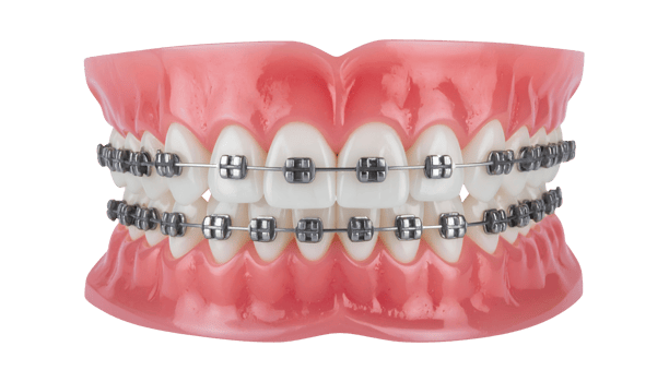 dental orthodontic model with metal braces, realistic teeth and gums anatomy for orthodontics training and dental education, full mouth bracket holder, on isolated background png