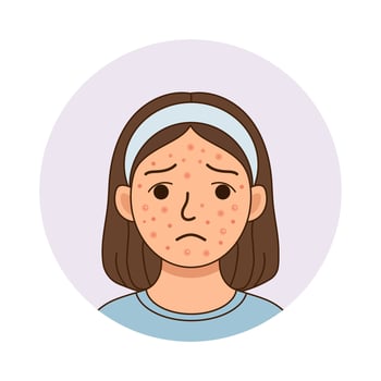 Acne prone face with pimples and redness. vector