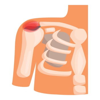Shoulder injury showing bones and muscles experiencing pain vector
