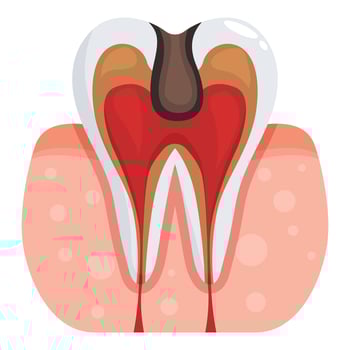 Deep tooth decay causing pulpitis and gum inflammation vector