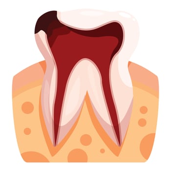 Deep tooth decay showing pulp and root canal vector