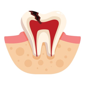 Diseased tooth showing pulpitis and affected dentin and enamel vector