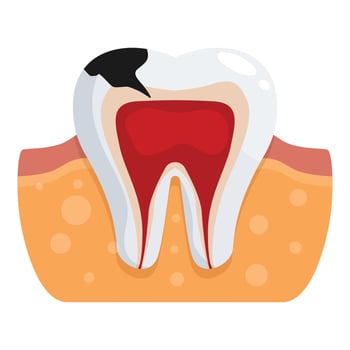 Diseased tooth showing pulpitis and black cavity, dental care concept vector