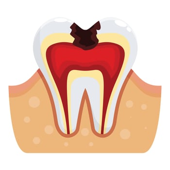 Deep tooth decay showing pulp and root canal inflamation vector