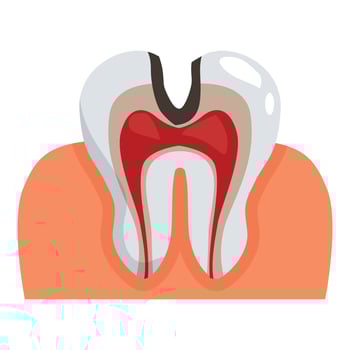 Carious tooth showing pulpitis and periodontitis with receding gums vector
