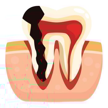 Decaying tooth showing cavity and inflammation in gums vector