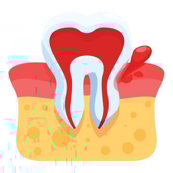 Bleeding tooth showing gingivitis and periodontitis symptoms vector