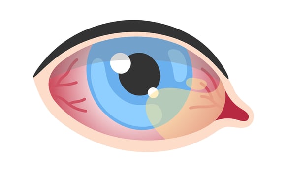 Pterygium Human Eye Disease vector