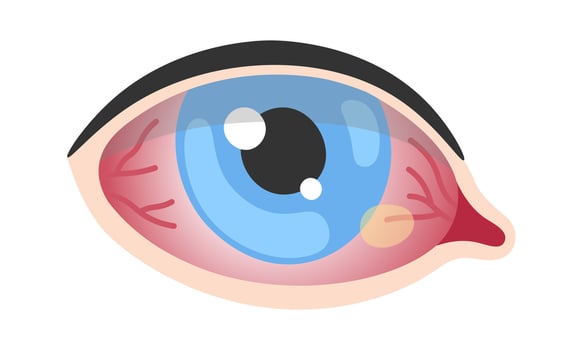 Pinguecula Human Eye Disease vector