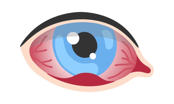 Stye Human Eye Disease vector