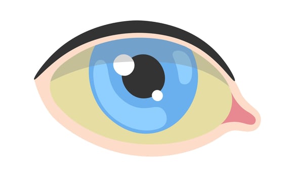 Jaundice Human Eye Disease vector