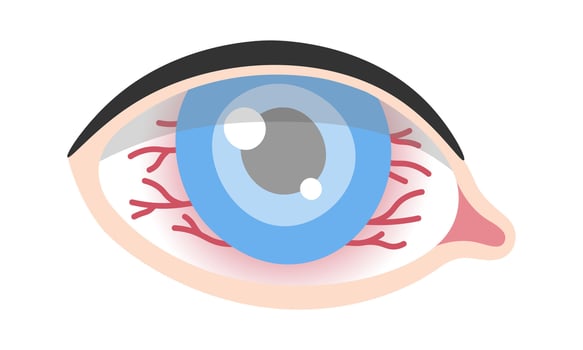 Corneal Herpes Parenchymal Eye Disease vector