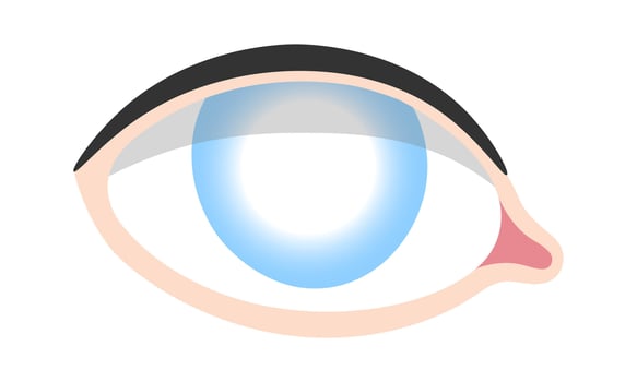 Cataract Human Eye Disease vector