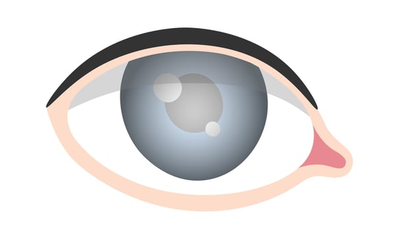 Glaucoma Eye Disease vector