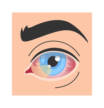 Pterygium Human Eye Disease Illustration vector