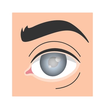 Glaucoma Human Eye Disease vector
