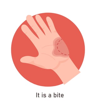 Bite On Hand Symptom Illustration vector