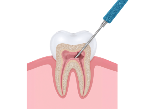 Illustration showcasing root canal procedure with dental instrument in a tooth section png